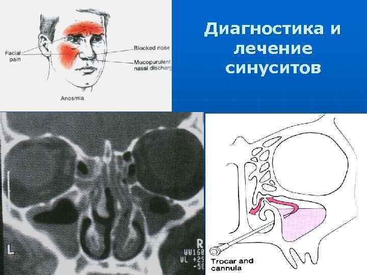 Частые синуситы