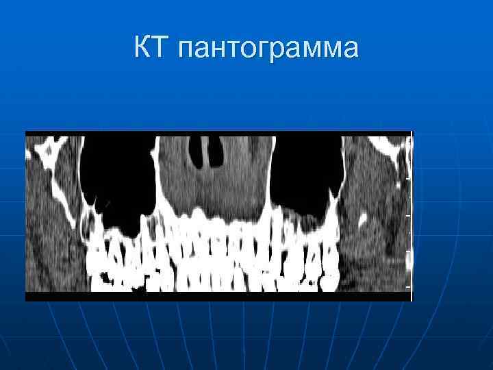 КТ пантограмма 