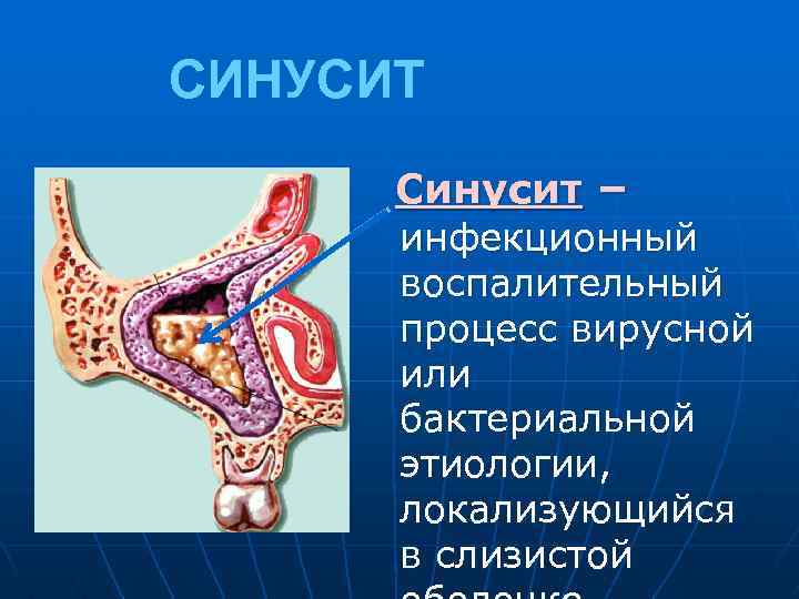 СИНУСИТ Синусит – инфекционный воспалительный процесс вирусной или бактериальной этиологии, локализующийся в слизистой 