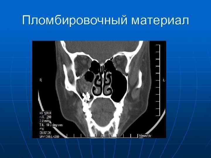 Пломбировочный материал 