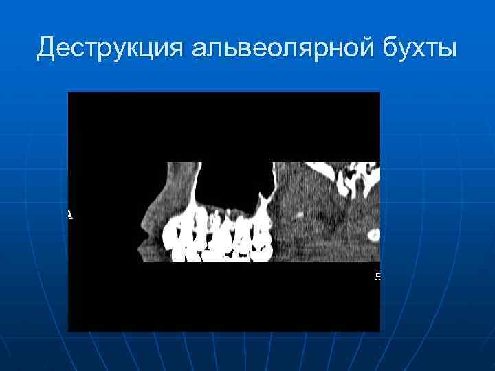 Деструкция альвеолярной бухты 