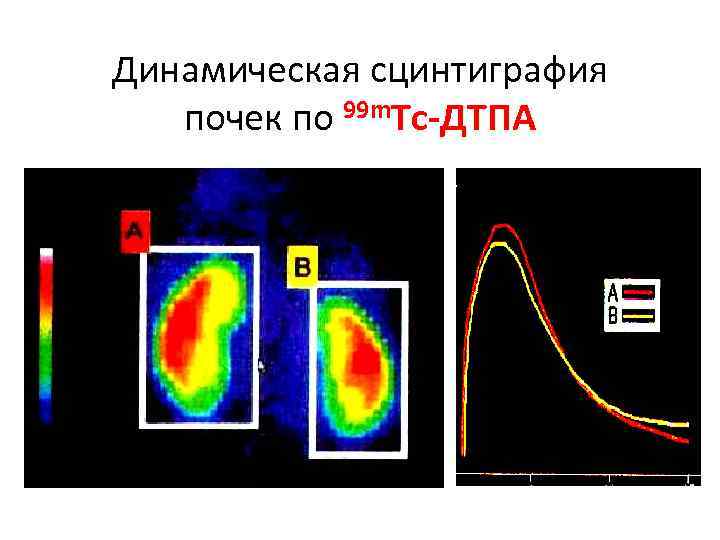 Динамическая сцинтиграфия почек по 99 m. Tc-ДТПА 