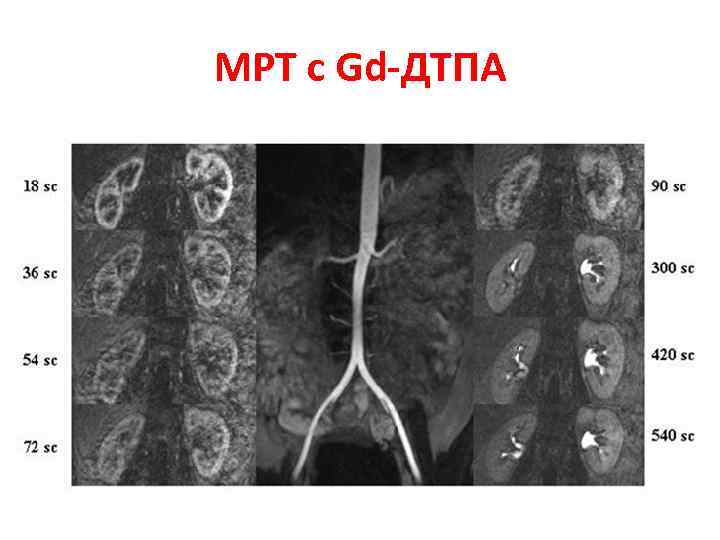 МРТ с Gd-ДТПА 