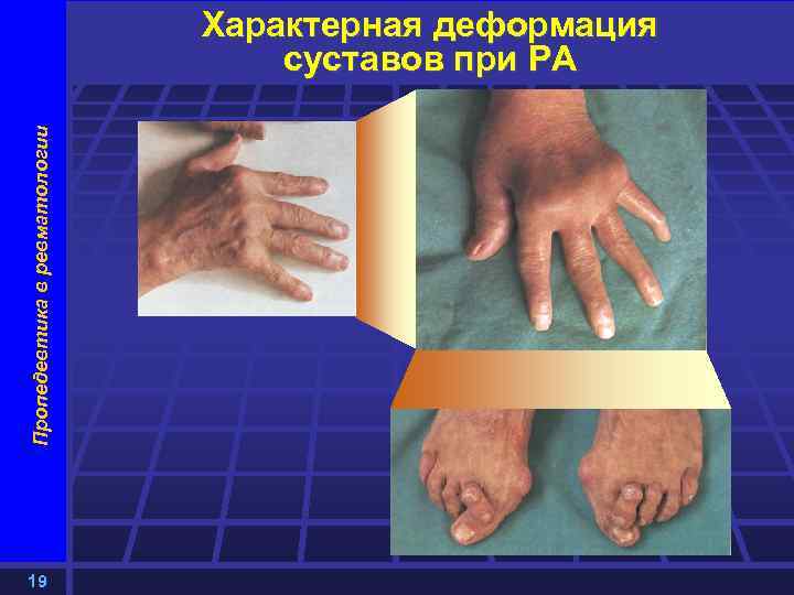 Пропедевтика в ревматологии Характерная деформация суставов при РА 19 