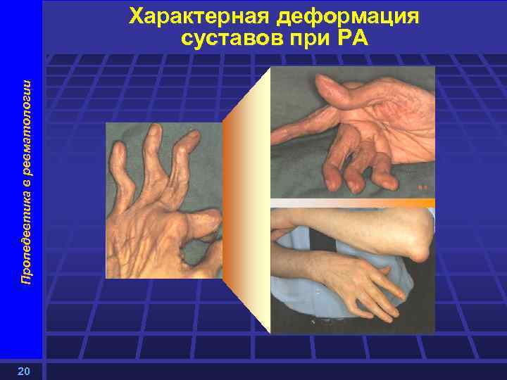 Пропедевтика в ревматологии Характерная деформация суставов при РА 20 