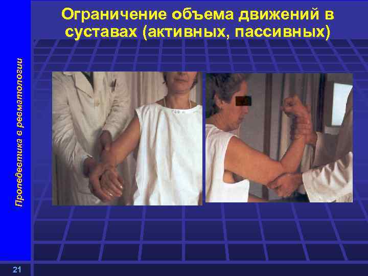 Пропедевтика в ревматологии Ограничение объема движений в суставах (активных, пассивных) 21 
