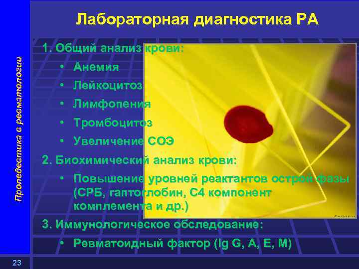 Пропедевтика в ревматологии Лабораторная диагностика РА 1. Общий анализ крови: • Анемия • Лейкоцитоз