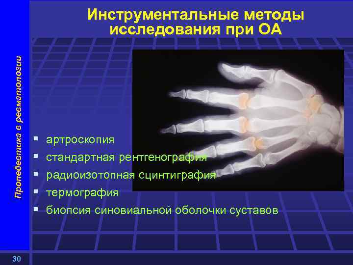Пропедевтика в ревматологии Инструментальные методы исследования при ОА 30 § § § артроскопия стандартная