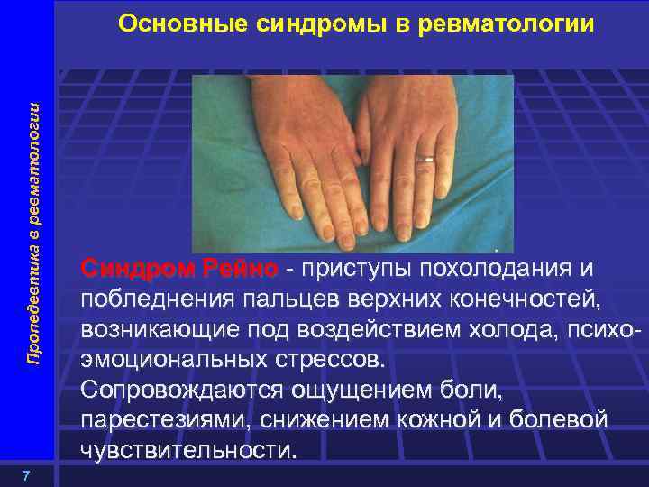 Пропедевтика в ревматологии Основные синдромы в ревматологии 7 Синдром Рейно - приступы похолодания и
