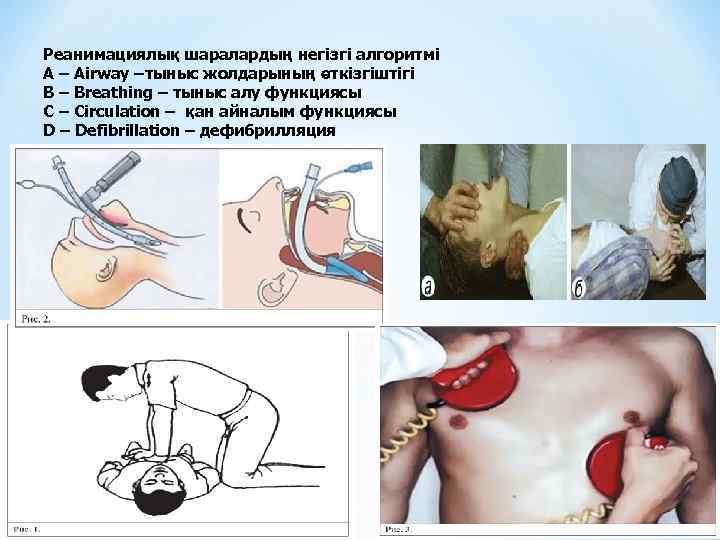Реанимациялық шаралардың негізгі алгоритмі A – Airway –тыныс жолдарының өткізгіштігі B – Breathing –