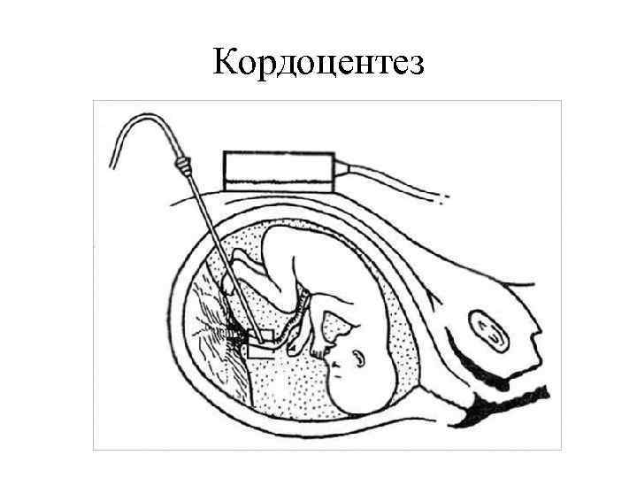 Кордоцентез 