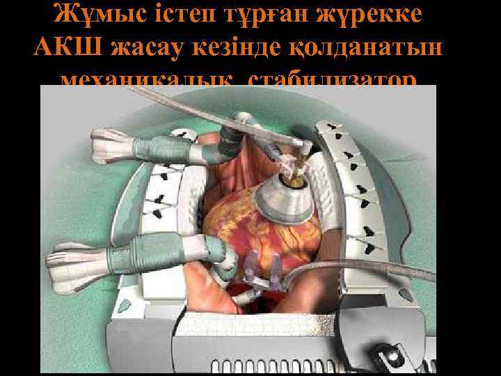 Жұмыс істеп тұрған жүрекке АКШ жасау кезінде қолданатын механикалық стабилизатор 