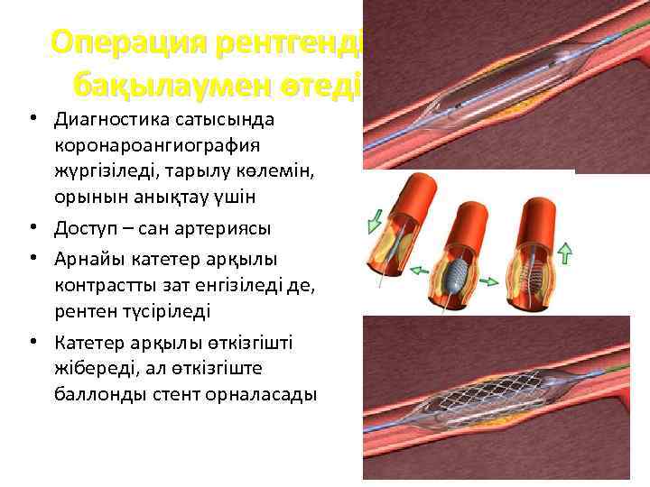 Операция рентгендік бақылаумен өтеді • Диагностика сатысында коронароангиография жүргізіледі, тарылу көлемін, орынын анықтау үшін