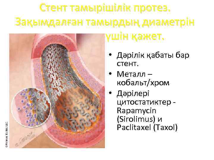 Стент тамырішілік протез. Зақымдалған тамырдың диаметрін сақтап тұру үшін қажет. • Дәрілік қабаты бар