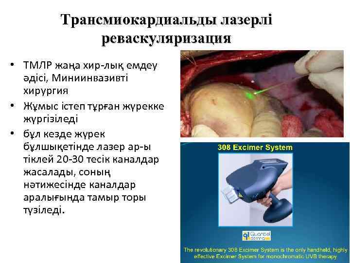 Трансмиокардиальды лазерлі реваскуляризация • ТМЛР жаңа хир-лық емдеу әдісі, Миниинвазивті хирургия • Жұмыс істеп