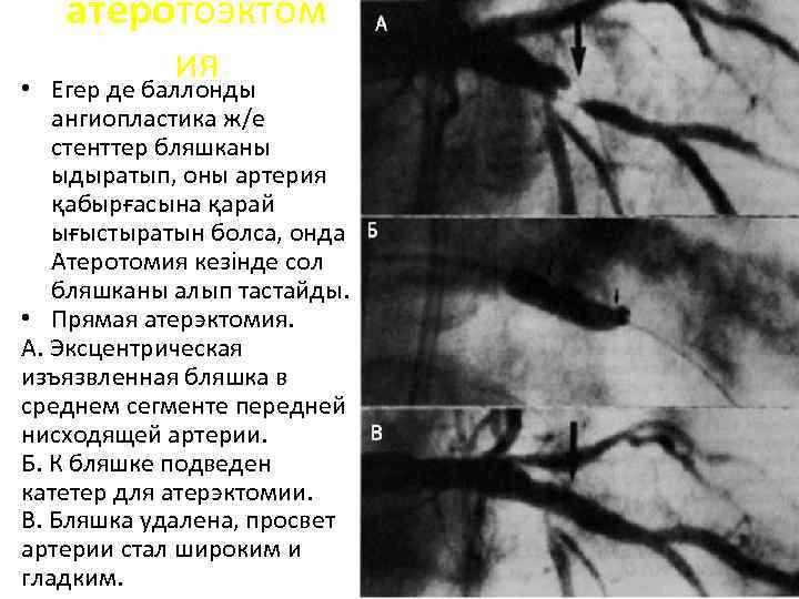  • атеротоэктом ия Егер де баллонды ангиопластика ж/е стенттер бляшканы ыдыратып, оны артерия