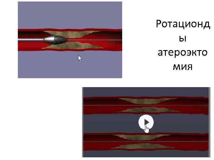 Ротационд ы атероэкто мия 
