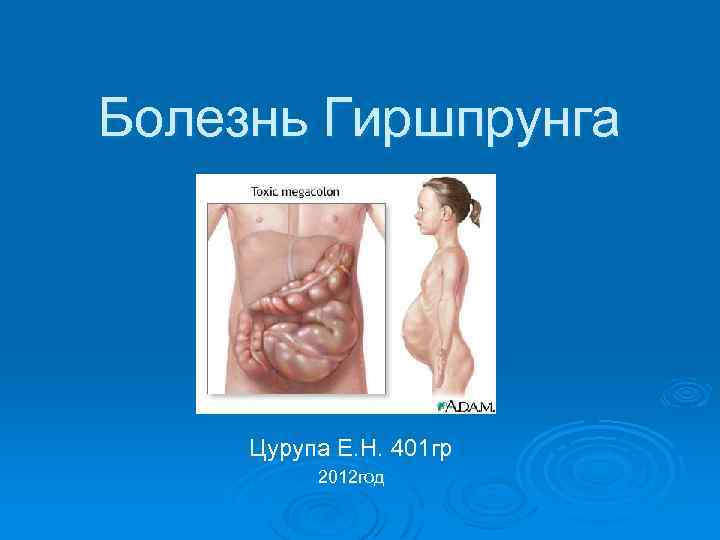 Болезнь Гиршпрунга Цурупа Е. Н. 401 гр 2012 год 