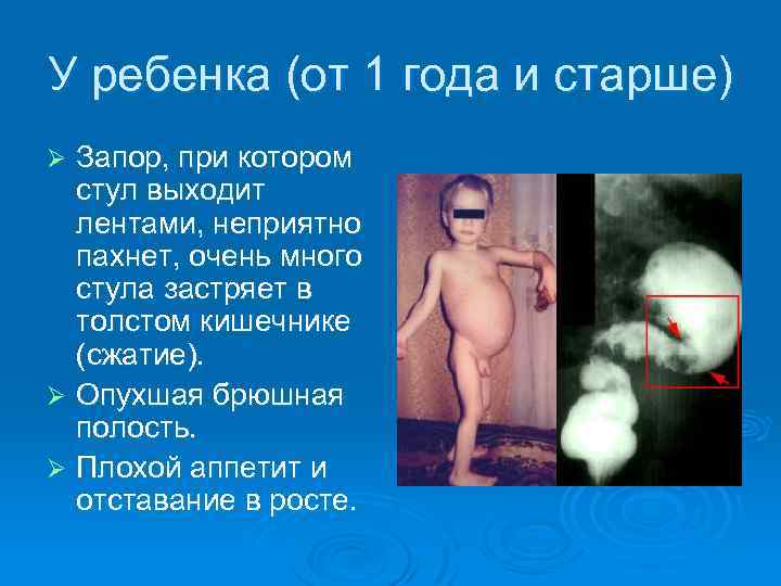 У ребенка (от 1 года и старше) Запор, при котором стул выходит лентами, неприятно