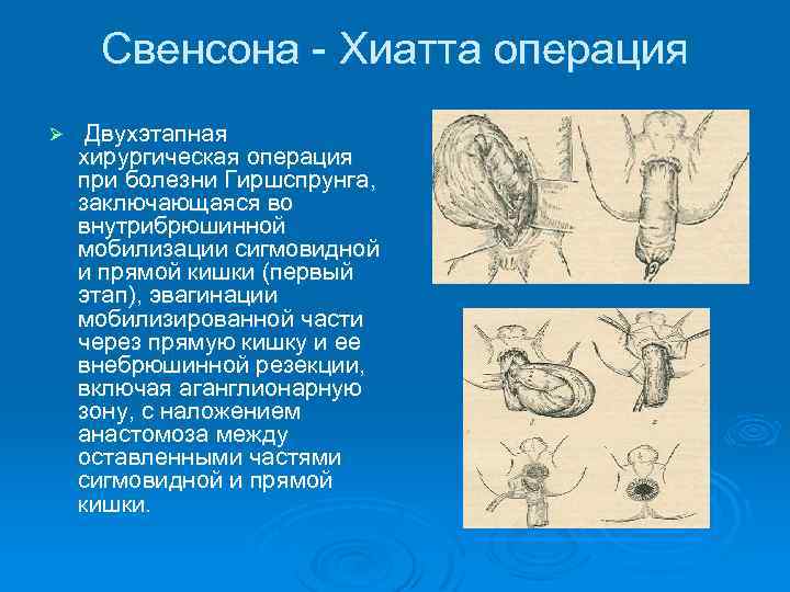 Свенсона - Хиатта операция Ø Двухэтапная хирургическая операция при болезни Гиршспрунга, заключающаяся во внутрибрюшинной