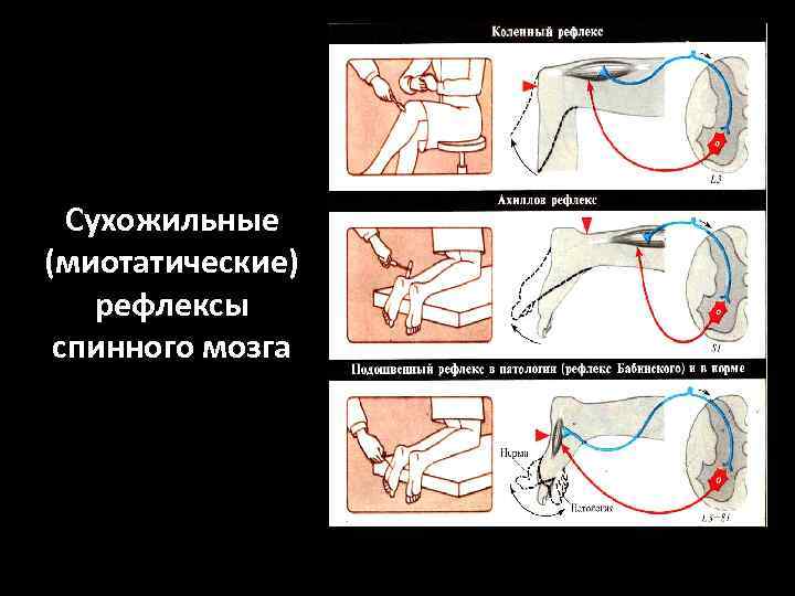 Сухожильные (миотатические) рефлексы спинного мозга 