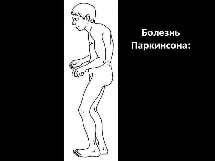 Болезнь Паркинсона: ригидность, тремор покоя, акинезия, эмоциональная тупость 