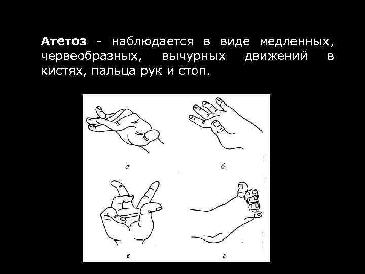 Атетоз - наблюдается в виде медленных, червеобразных, вычурных движений в кистях, пальца рук и