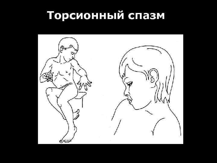 Торсионный спазм 