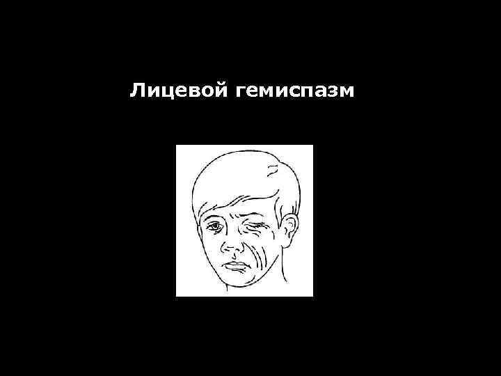 Лицевой гемиспазм 
