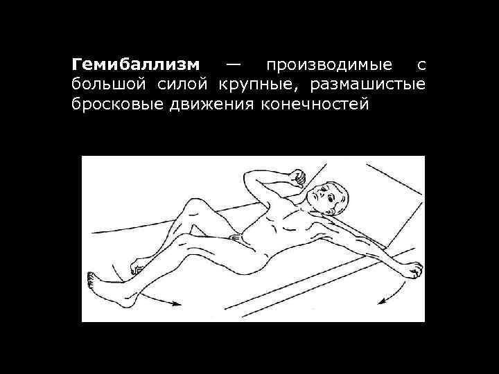 Гемибаллизм — производимые с большой силой крупные, размашистые бросковые движения конечностей 