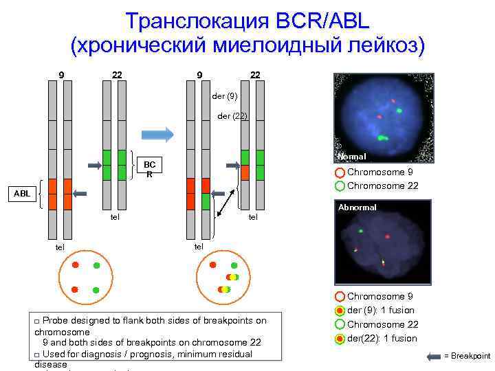 Транслокация BCR/ABL (хронический миелоидный лейкоз) 9 22 der (9) der (22) Normal BC R