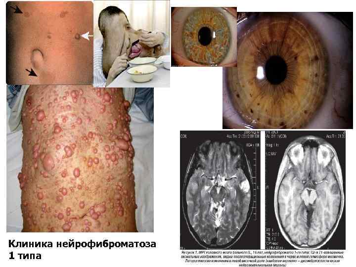 Клиника нейрофиброматоза 1 типа 