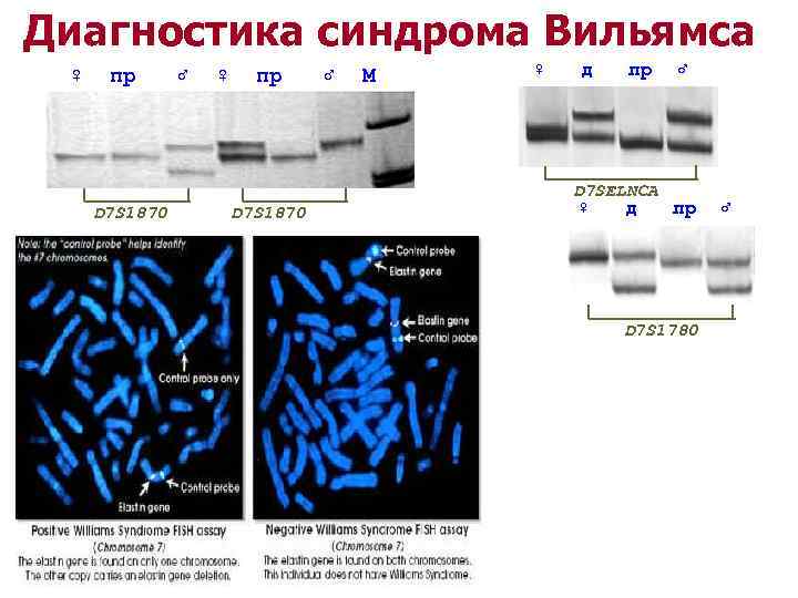 Синдром вильямса кэмпбелла презентация