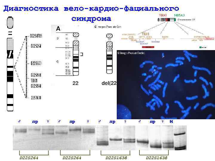 Диагностика вело-кардио-фациального синдрома ♂ пр ♀ ♂ пр ♀ М D 22 S 264