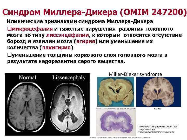 Синдром менкеса фото