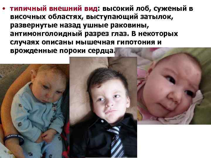  • типичный внешний вид: высокий лоб, суженый в височных областях, выступающий затылок, развернутые