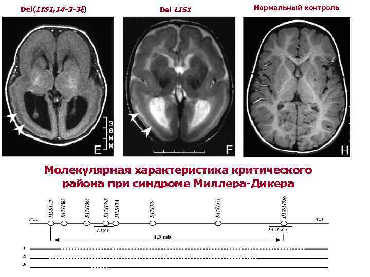 Del(LIS 1, 14 -3 -3ξ) Del LIS 1 Нормальный контроль Молекулярная характеристика критического района