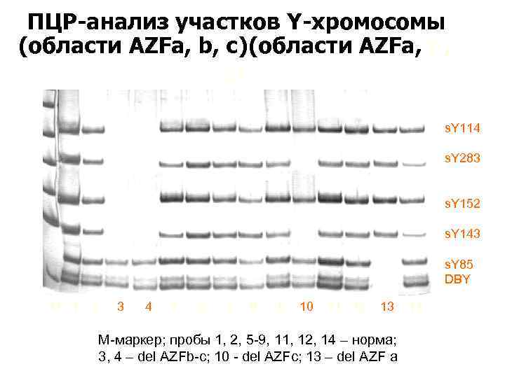 ПЦР-анализ участков Y-хромосомы (области AZFа, b, с) s. Y 114 s. Y 283 s.