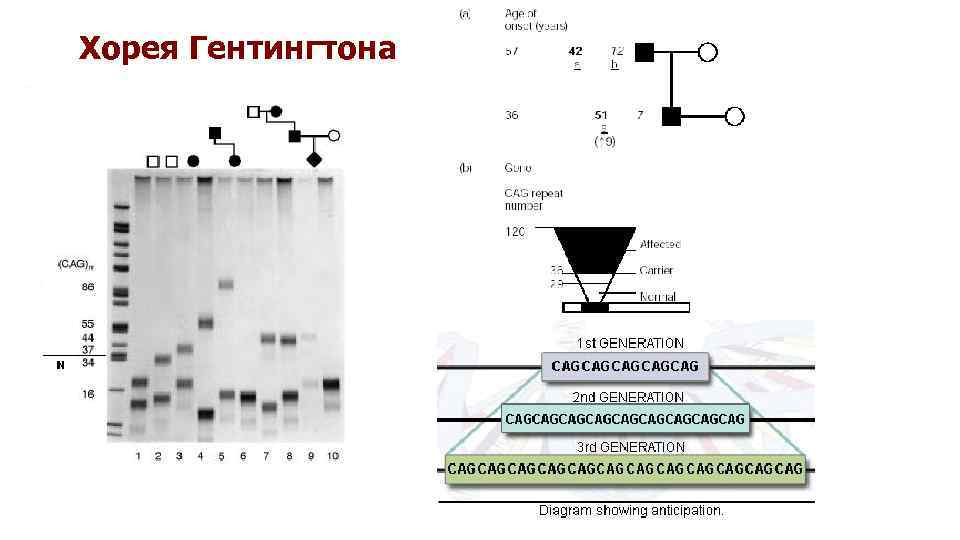 Хорея Гентингтона 