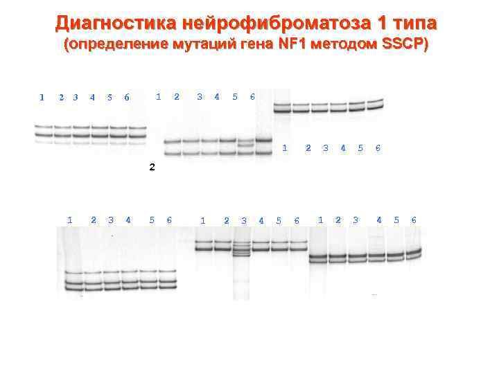 Диагностика нейрофиброматоза 1 типа (определение мутаций гена NF 1 методом SSCP) 1 2 3