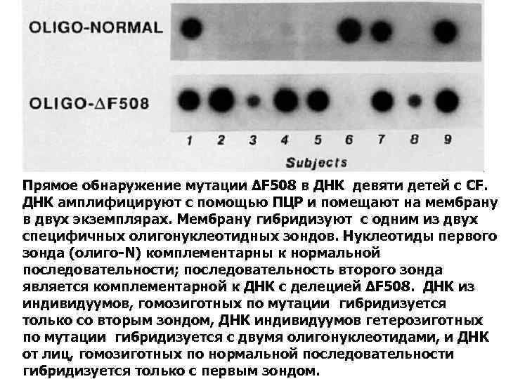 Прямое обнаружение мутации ΔF 508 в ДНК девяти детей с CF. ДНК амплифицируют с
