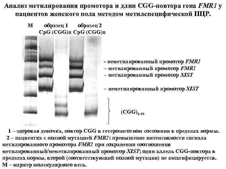 Анализ метилирования промотора и длин CGG-повтора гена FMR 1 у пациентов женского пола методом