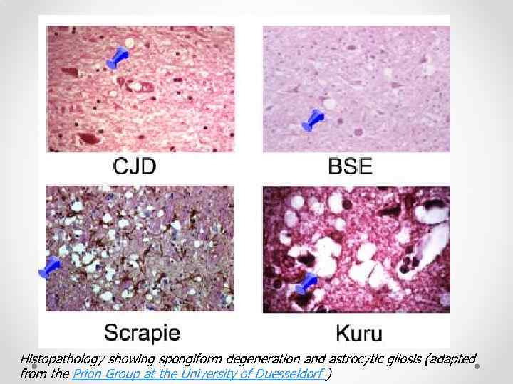 Histopathology showing spongiform degeneration and astrocytic gliosis (adapted from the Prion Group at the