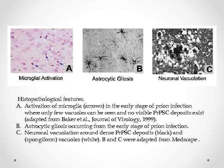  Histopathological features. A. Activation of microglia (arrows) in the early stage of prion