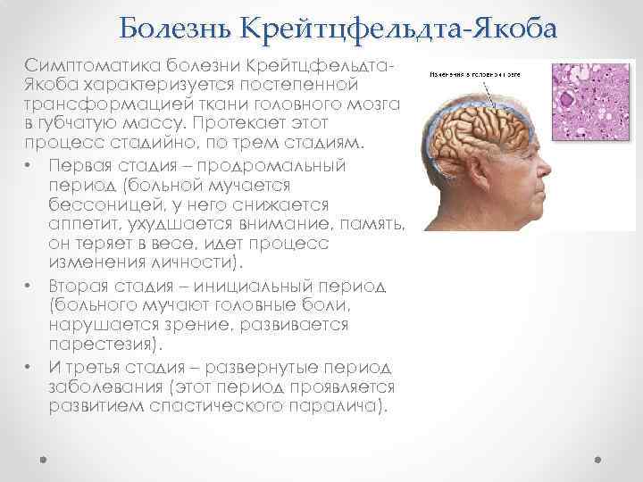Болезнь Крейтцфельдта-Якоба Симптоматика болезни Крейтцфельдта. Якоба характеризуется постепенной трансформацией ткани головного мозга в губчатую