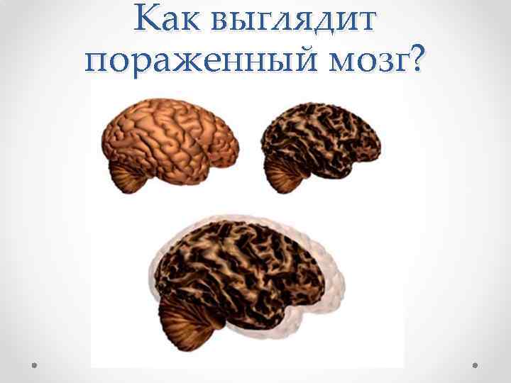 Как выглядит пораженный мозг? 