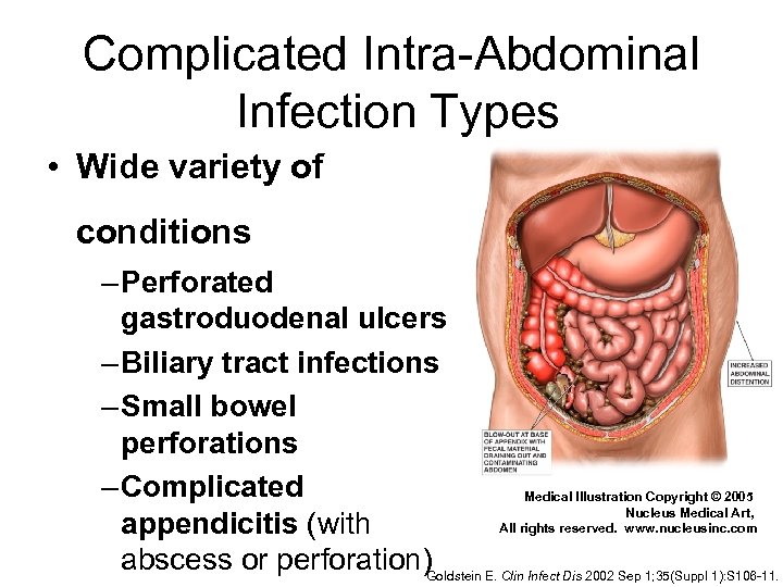 Complicated Intra-Abdominal Infection Types • Wide variety of conditions – Perforated gastroduodenal ulcers –