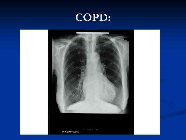 COPD: 