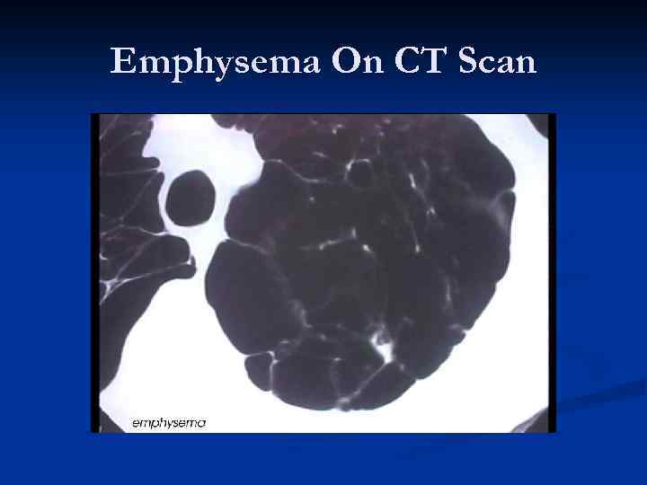 Emphysema On CT Scan 