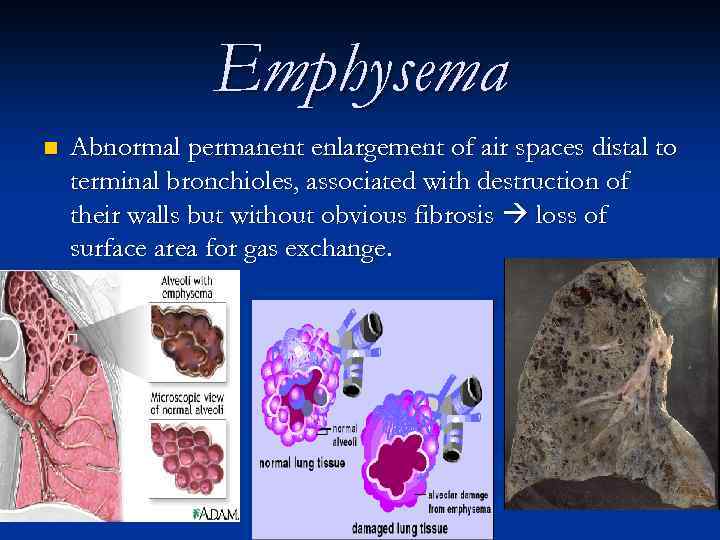 Emphysema n Abnormal permanent enlargement of air spaces distal to terminal bronchioles, associated with